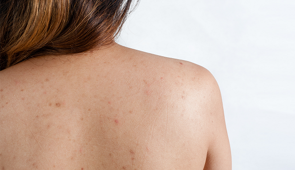 Tẩy tế bào chết body giúp ngừa mụn